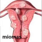 miomas miomas uterinos